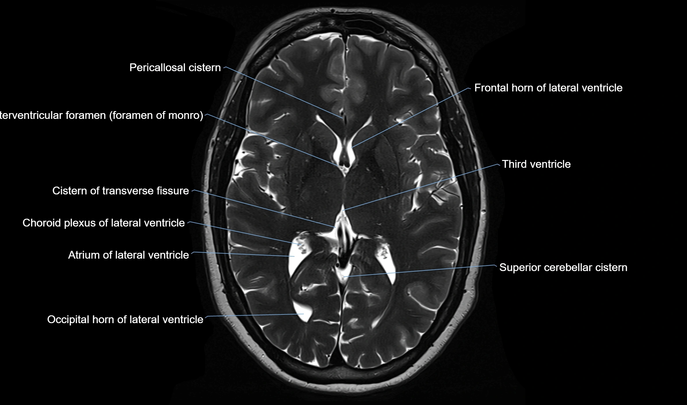 Brain cisterns  and ventricles  axial anatomy 3T MRI image-img-00001-00029.webp